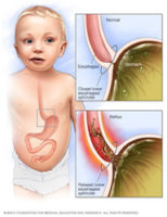 Reflusso gastro esofageo Fisioterapia Roma